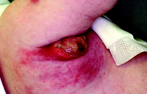 vaccin bcg comment ca se passe