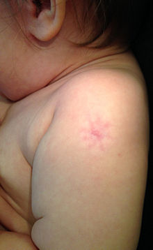 vaccin bcg comment ca se passe