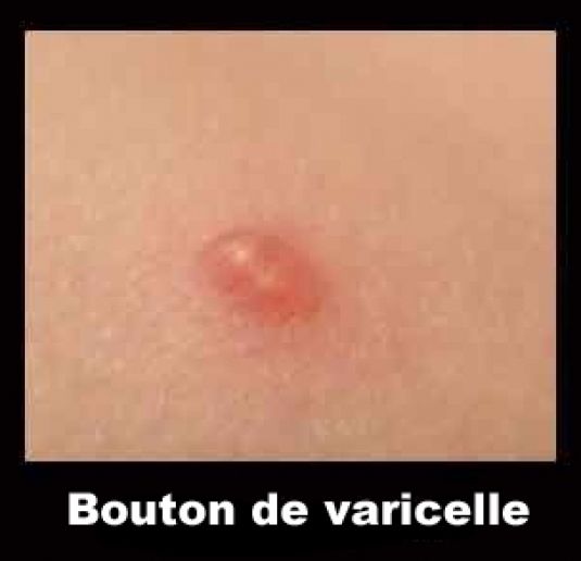 vaccin varicelle nom