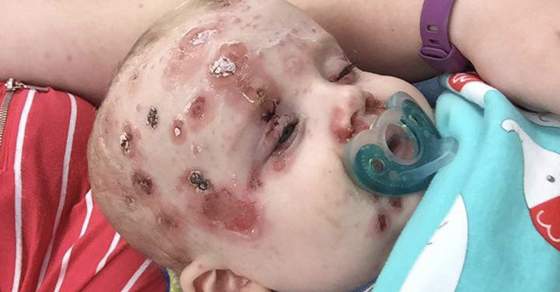 vaccin varicelle nom