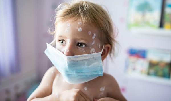 vaccin windpokken bijwerkingen