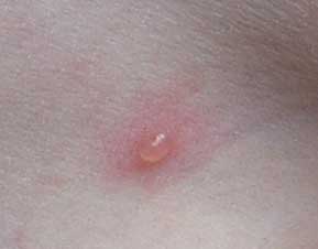 vaccin windpokken bijwerkingen